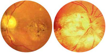 cmv retinitis